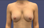 Breast Augmentation 12 After